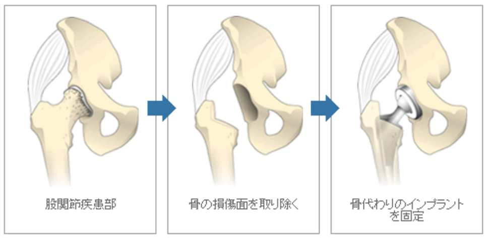 人工股関節置換術とは